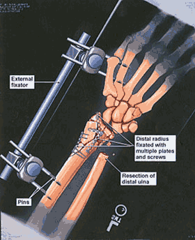 Arm Partially Amputated