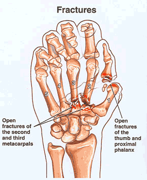 Hand Fractures