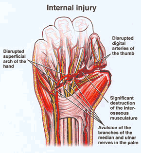 Hand internal Injury