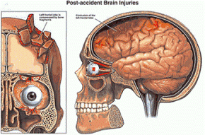 Post Accident Brain Injuries