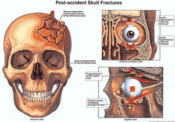 Post Accident Skull Fractures